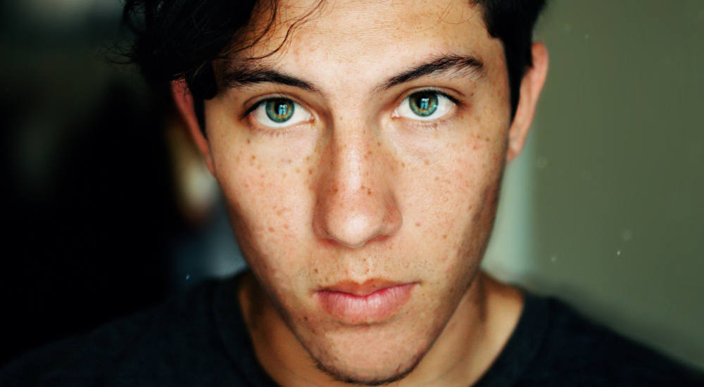 acne-juvenil-vigo-peq